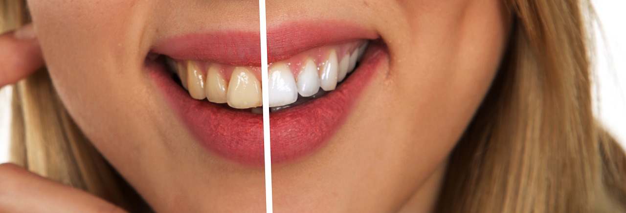 dentální hygiena, bělení zubů